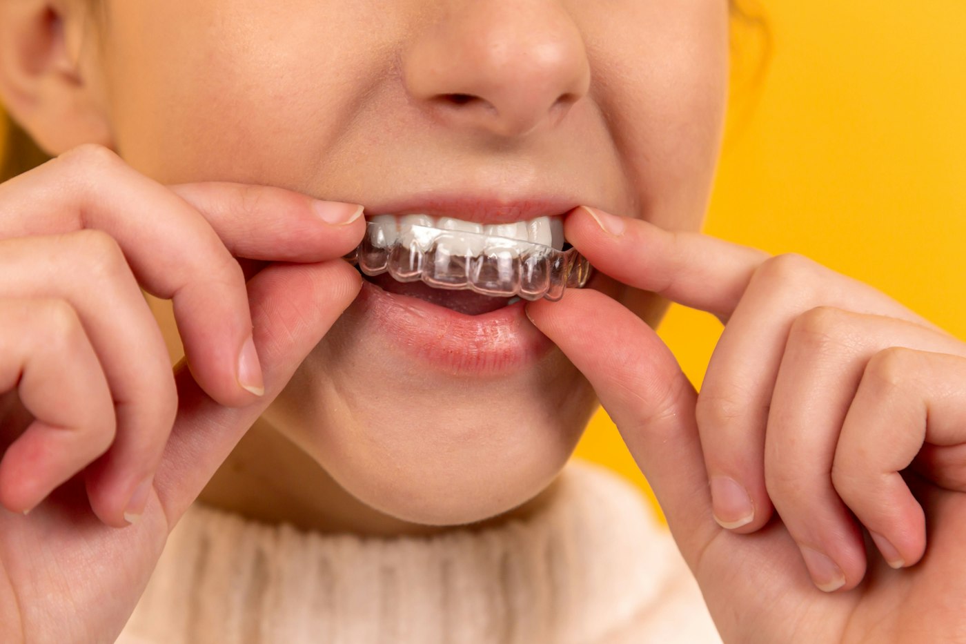 A person fitting a clear aligner over their teeth