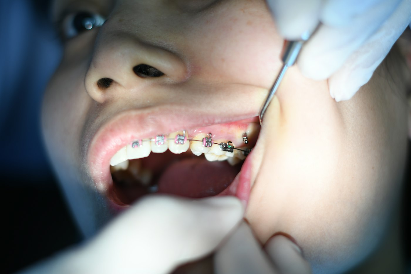 Close-up of a person wearing metal braces