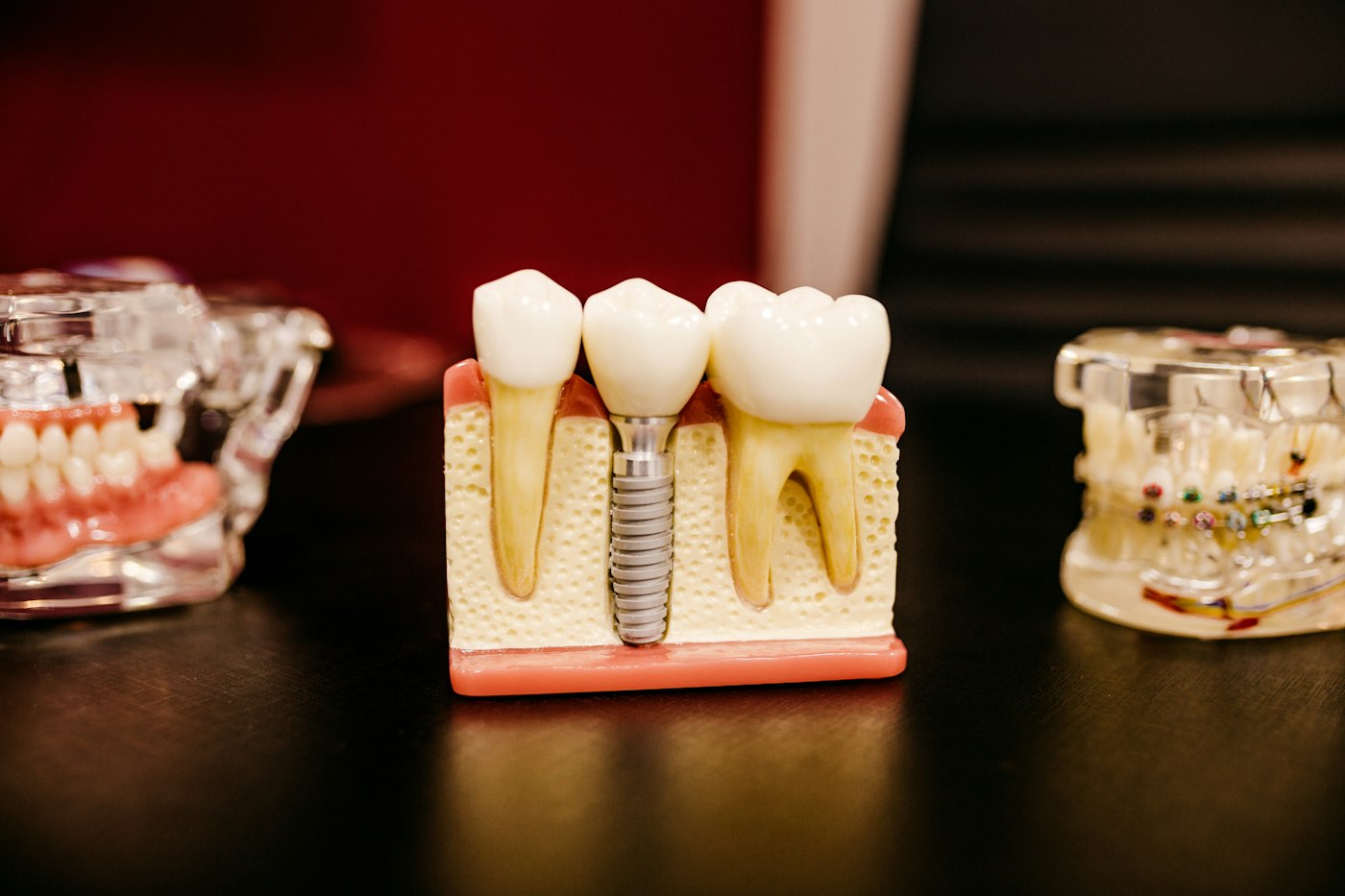 Model showing a dental implant beside natural teeth